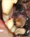 Dentalcaries1